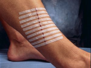 Cerotti 3M STERI-STRIP™ STRISCE PER SUTURA – 6 x 100 mm.  cf. 500 pz. (50 buste da 10 pz.) - immagine 3